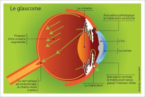 schéma oeil avec glaucome, une des conséquences du diabète