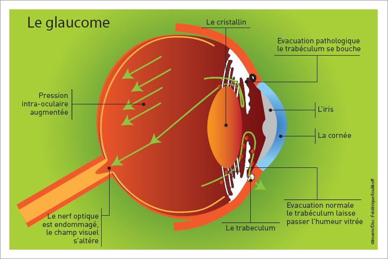 Schéma de l'oeil dans le cas d'un Glaucome