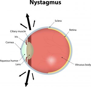 nystagmus