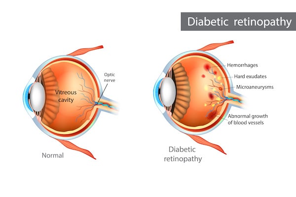 Effet de la rétinopathie diabétique sur un oeil