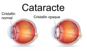 schéma oeil avec cataracte