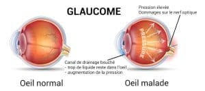 Schéma d'un oeil avec un glaucome