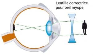 Verre de lunette concave pour la correction de la myopie