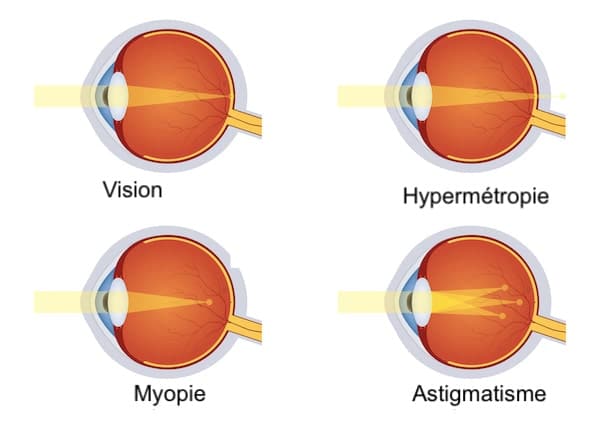 les défauts de réfraction : myopie, hypermétropie, astigmatisdme