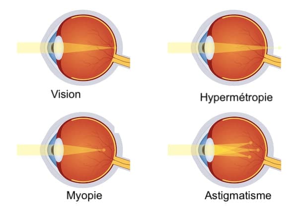 les défauts de réfractions : myopie, hypermétropie, astigmatisdme