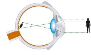 Schéma d'un oeil avec de l'astigmatisme