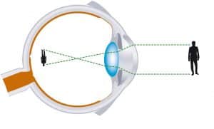 Schéma d'un oeil atteint de myopie, un des défauts de réfraction 