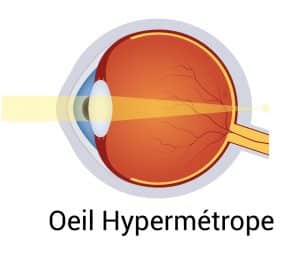 Schéma d'un oeil atteint d' hypermétropie