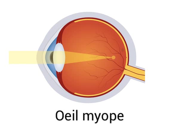 schéma d'un oeil myope